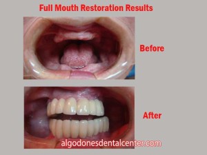 Full Mouth Restoration - Before-and-After - Los Algodones