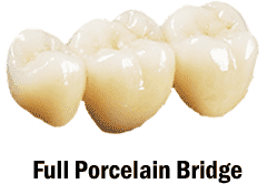 Full Porcelain Bridge