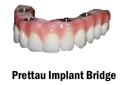 Prettau Implant Bridge