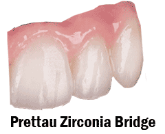 Prettau Zirconia Dental Restorations