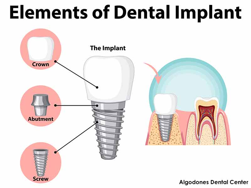 Dental Implants in Los Algodones