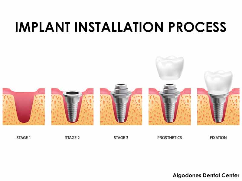 Implant Installation Process